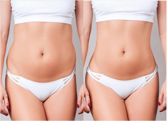 What makes FUE Hair Transplant Procedure the most Successful Technique?