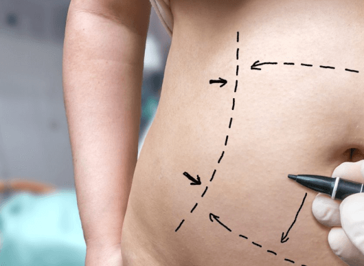 What makes FUE Hair Transplant Procedure the most Successful Technique?