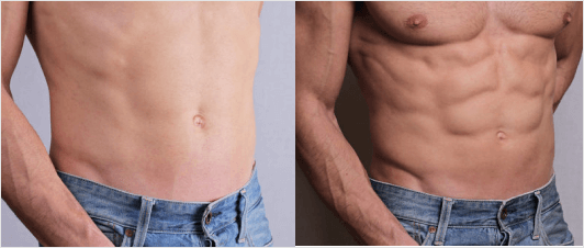 What makes FUE Hair Transplant Procedure the most Successful Technique?