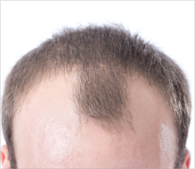 receding hairline treatment UK