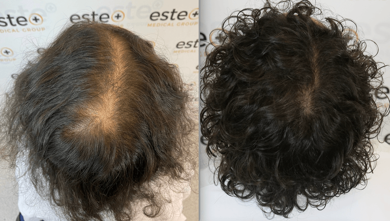 Amazing Hair Regrowth After Traumatic Female Hair Loss