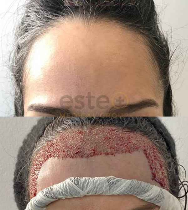 FUE Hair Transplant result