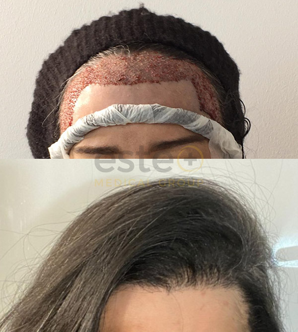 FUE Hair Transplant result