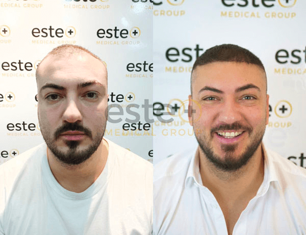 Hair transplant before and after Leeds