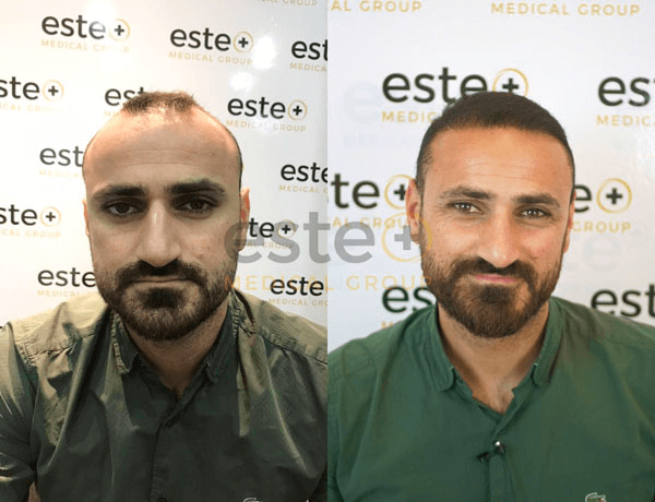 Hair transplant before and after Leeds