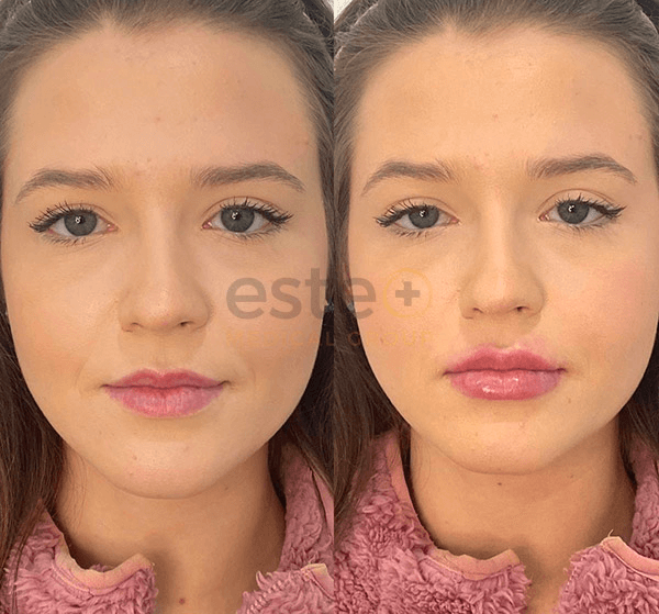 lip filler before after image