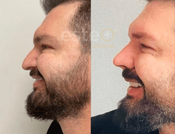 What makes FUE Hair Transplant Procedure the most Successful Technique?