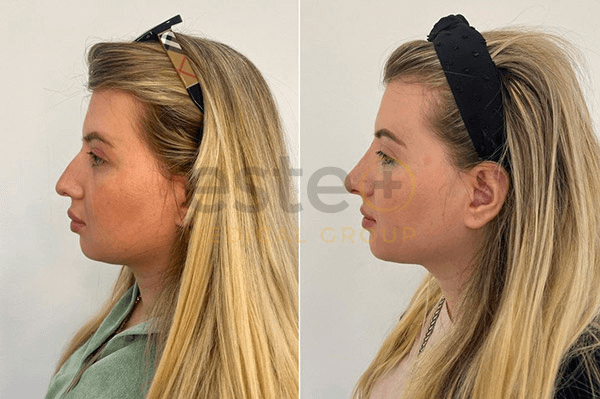 Nose Job Before and After Results