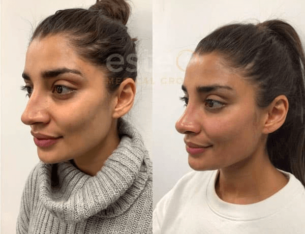 Nose Job Before and After Results