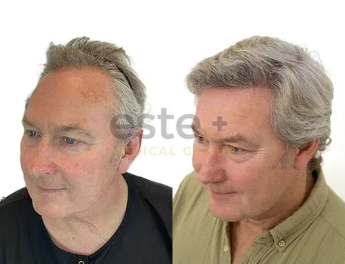 Hair Transplant result