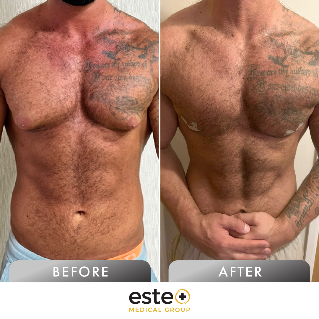 Breast Reduction Surgery before and after result