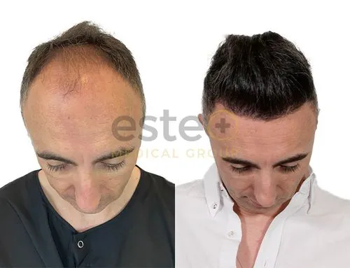 Hair treatment