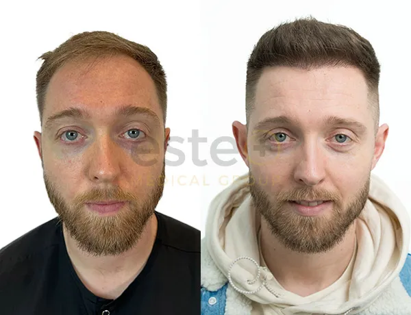 Hair Transplant before and after results