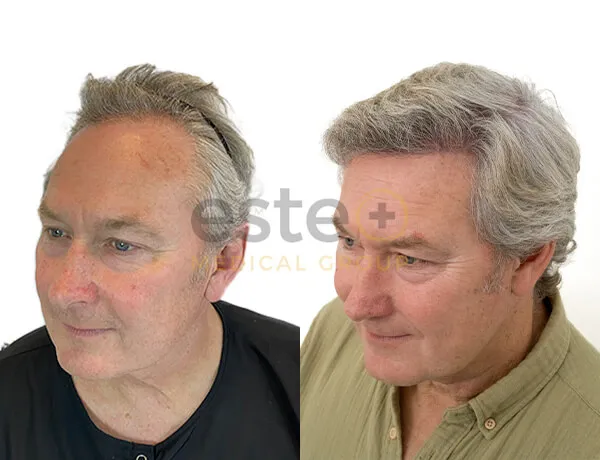 Hair Transplant before and after results