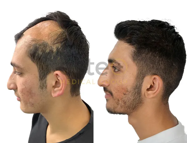 Hair Transplant Transformations
