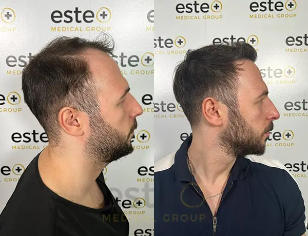 Hair transplant before and after Leeds