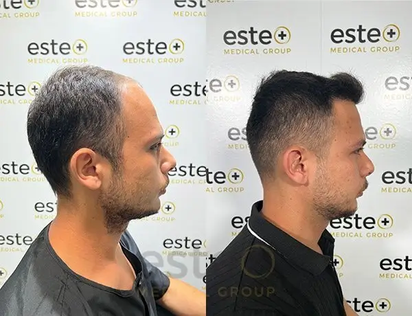 Hair transplant before and after Leeds