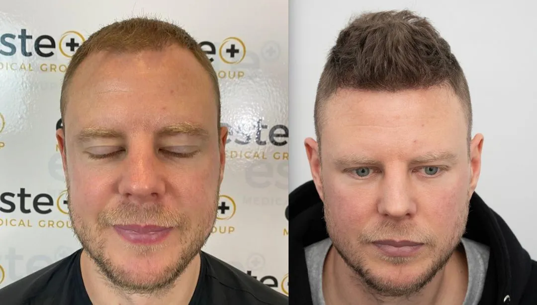 hair transplant before and after