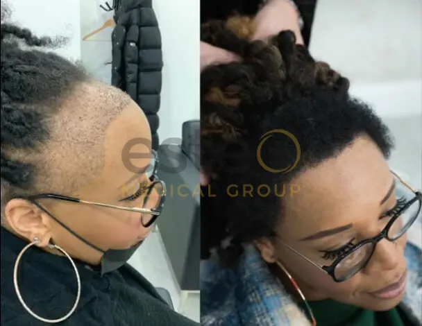 Micheale’s Outstanding Hair Transplant Transformation