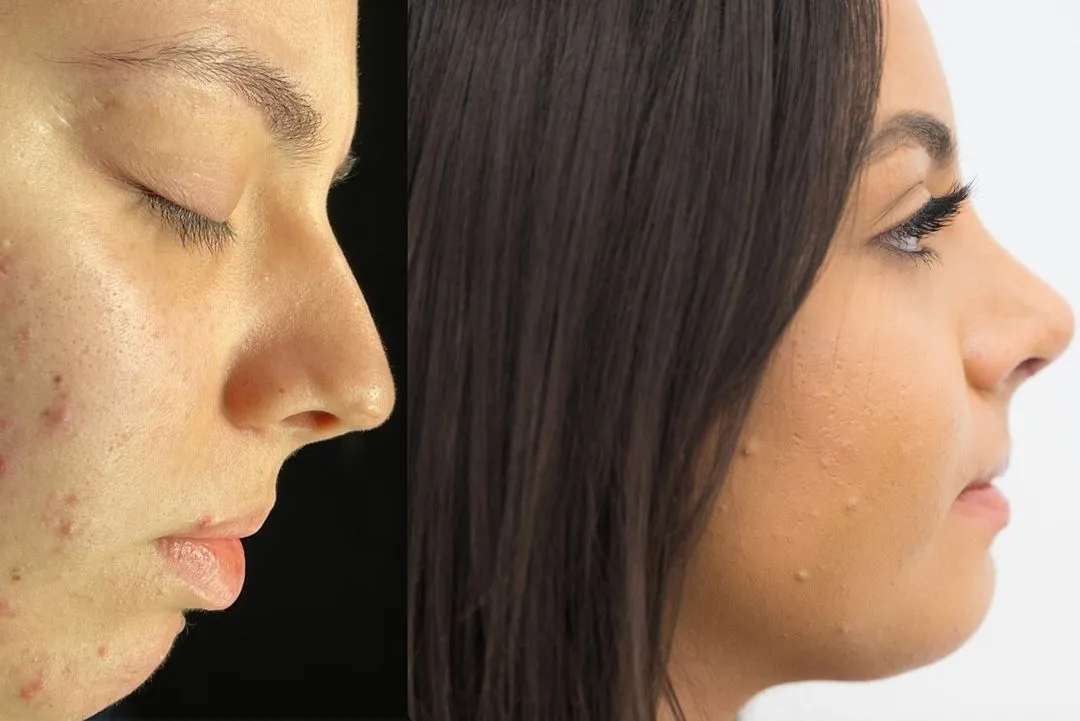 Rhinoplasty in Turkey