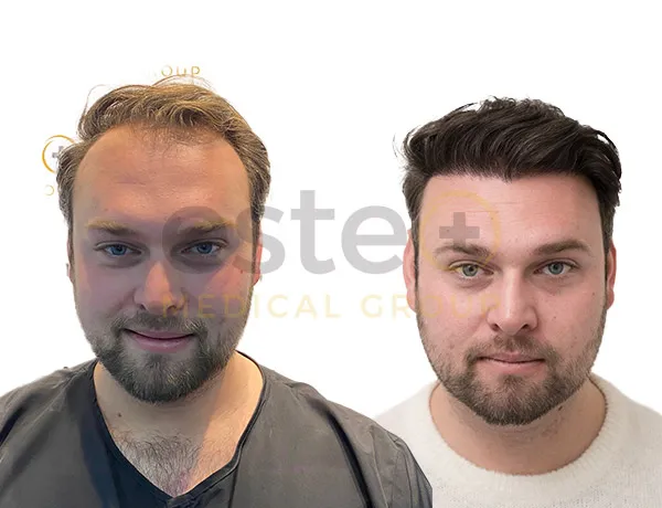 Turkey hair transplant