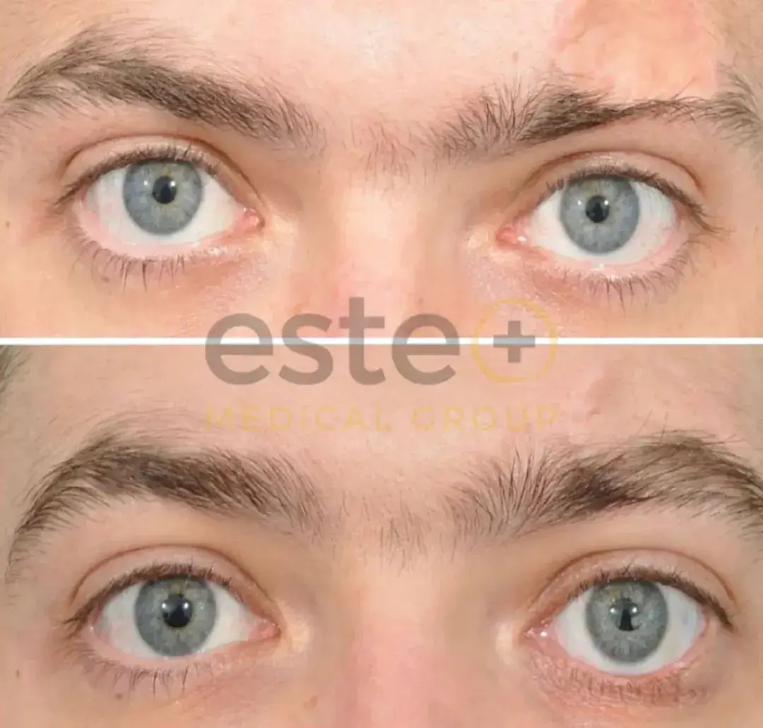 Eyebrow Transplant before after results