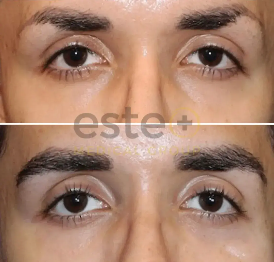 Eyebrow Transplant before after results